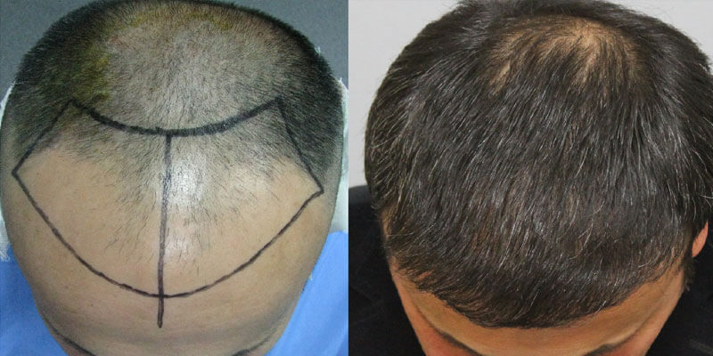 Hair transplant before and after image