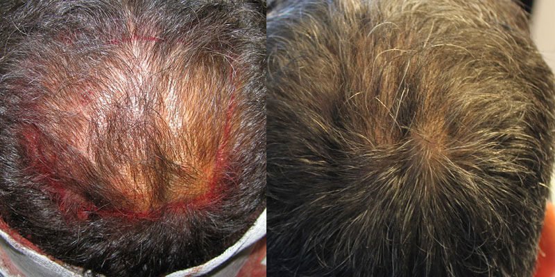 Hair transplant before and after image
