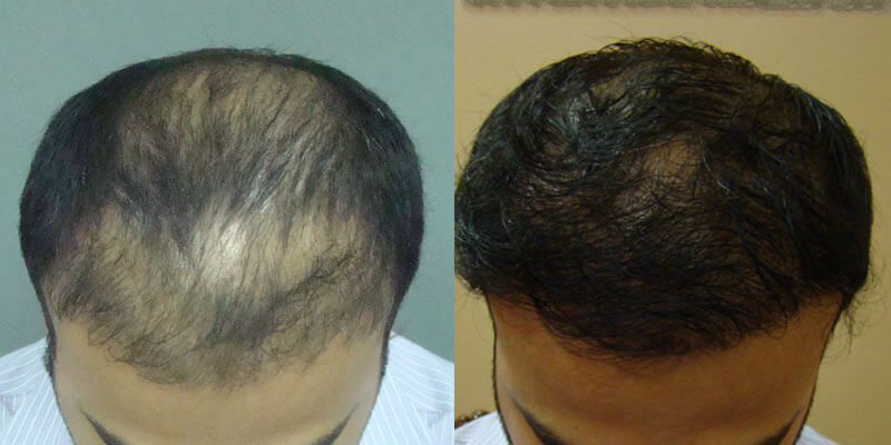 Hair transplant before and after image