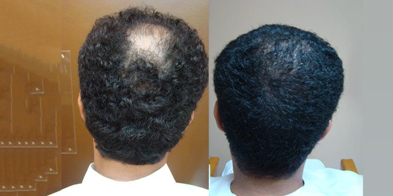 hair transplant before and after