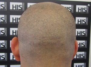 Hair-Transplant-Scar11-300x221 (1)