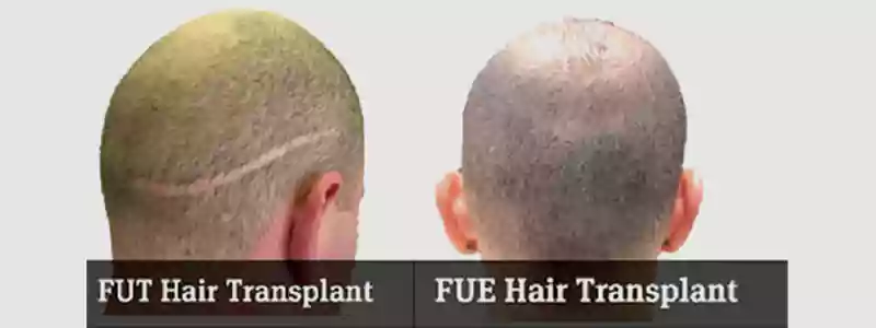 Hair transplant cost in Dubai
