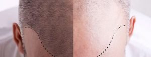 ACell PRP Therapy for Hair Restoration