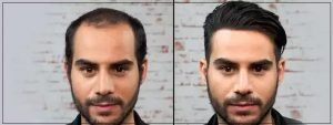 Hair Restoration Dubai