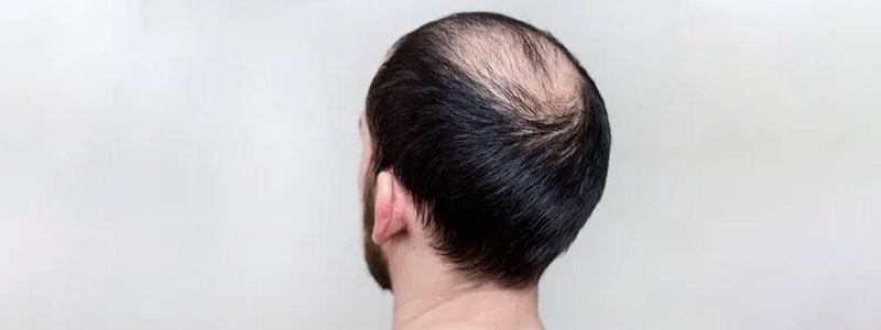 Hair Fillers for Baldness