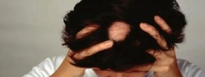 Alopecia Areata Treatment Dubai