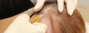 PRP (Platelet Rich Plasma) For Hair Loss in Dubai