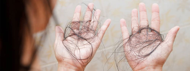 Hair loss treatment in Dubai