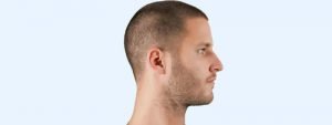 Scalp MicroPigmentation(SMP) - Hair Tattoo Dubai