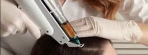 Mesotherapy for Hair Loss Dubai