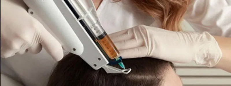 Mesotherapy for Hair Loss Dubai