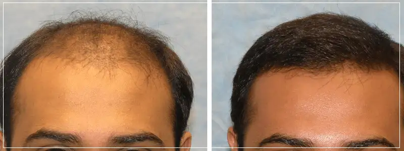 How to Slow Down the Balding Process | Hair Transplant Dubai