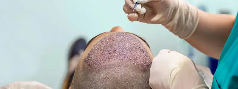 Hair transplant in Dubai