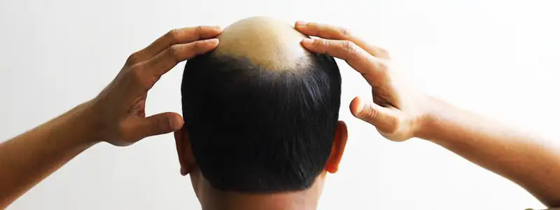 Know All About Men Hair Loss Treatment Hacks | Hair Transplant Dubai