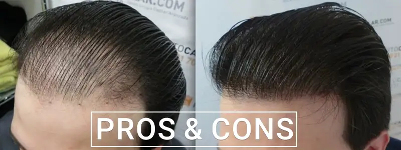 Pros and Cons of Scalp Micropigmentation: One Year On - Foli Sim
