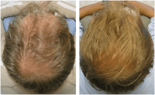 Alopecia before and after