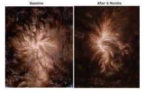 Alopecia before and after